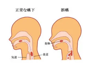 嚥下と誤嚥